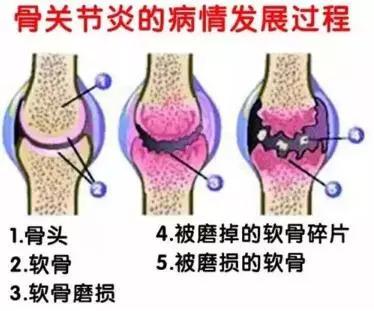 膝关节术后吃 氨糖软骨素有效吗？氨糖软骨素哪个牌子好？「氨糖软骨素有效吗,氨糖软骨素,软骨素,氨糖,氨糖软骨素哪个牌子好」