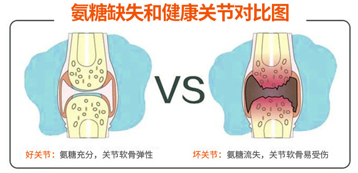 吃氨糖软骨素的注意事项有哪些