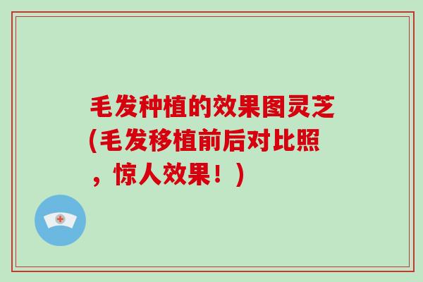 毛发种植的效果图灵芝(毛发移植前后对比照,惊人效果!)-第1张图片-灵芝大师 毛发种植的效果图灵芝(毛发移植前后对比照,惊人效果!)-第1张图片-灵芝大师